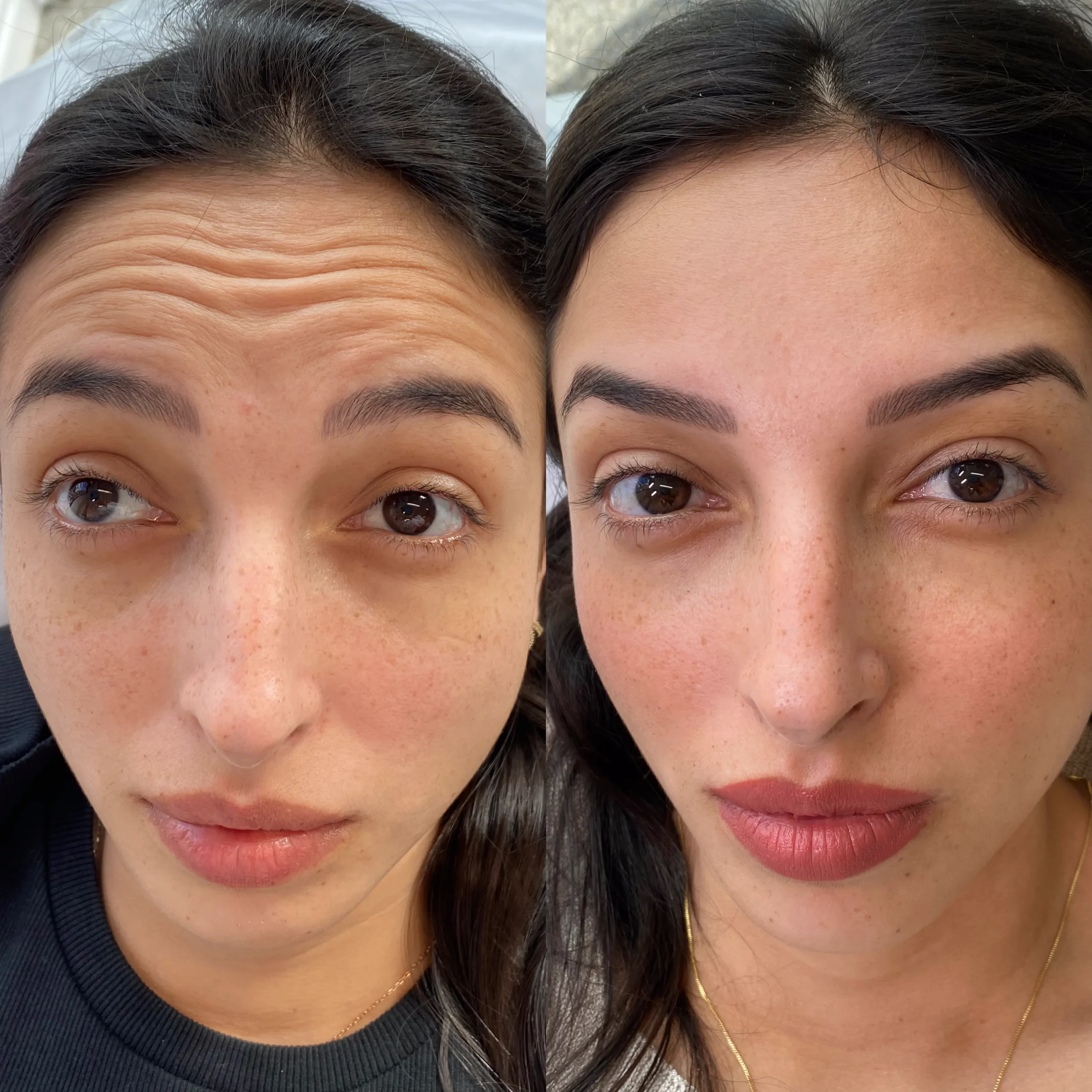AnyConv.com__Botox-2