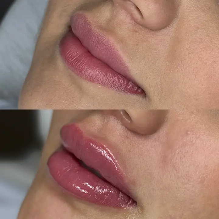 AnyConv.com__Lip-filler-1