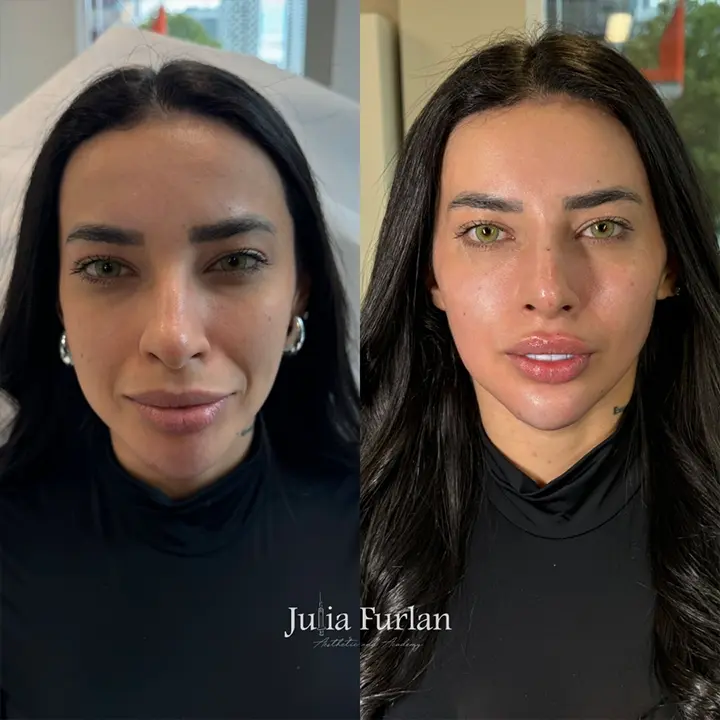 AnyConv.com__dermal-filler-1